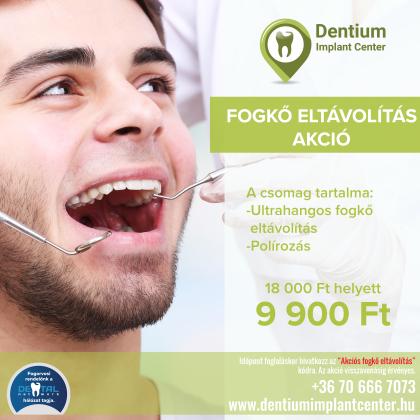 Fogkő Eltávolítás Akció Fogkő Eltávolítás Akció