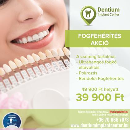 Fogfehérítés AKCIÓ Fogfehérítés AKCIÓ