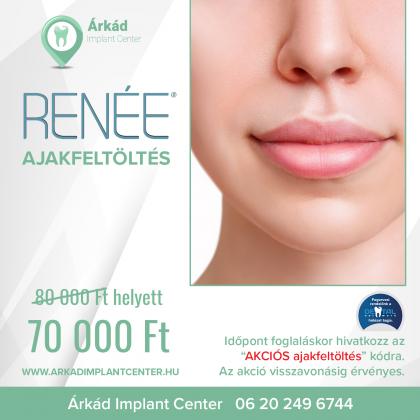 RENÉE Ajak feltöltés AKCIÓ RENÉE Ajak feltöltés AKCIÓ