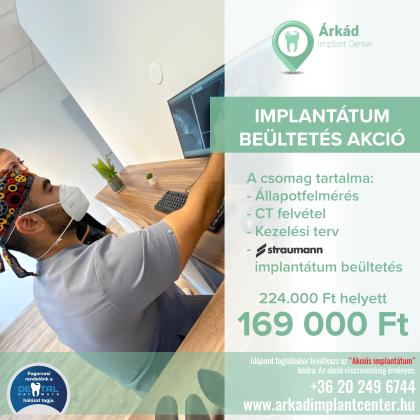 Implantátum beültetés akciós csomag