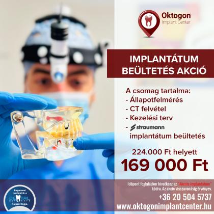 Implantátum beültetés akciós csomag