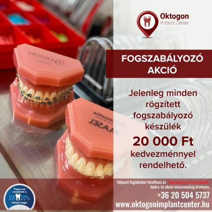 Fogszabályozás AKCIÓ