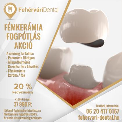 Fémkerámia Korona Akció Fémkerámia Korona Akció