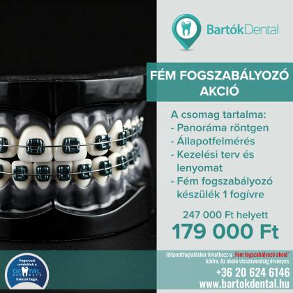 Fém Fogszabályozó Akció Fém Fogszabályozó Akció