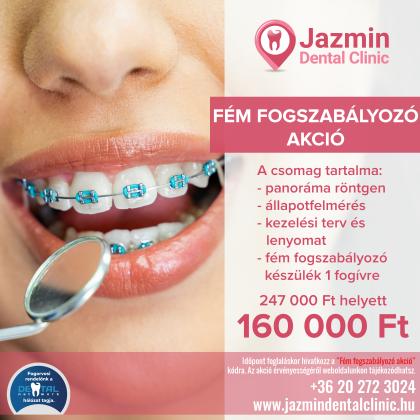 Fém Fogszabályozó Akció Fém Fogszabályozó Akció