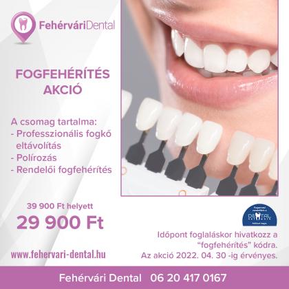 Fogfehérítés Akció Fogfehérítés Akció