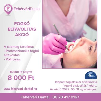 Fogkő Eltávolítás Akció Fogkő Eltávolítás Akció