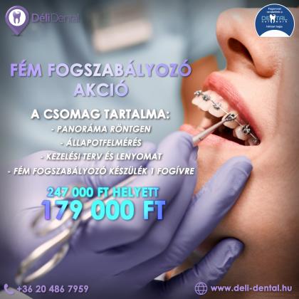 Fém Fogszabályozó Akció