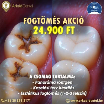 Fogtömés Akció Fogtömés Akció