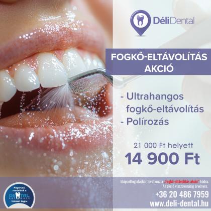 Fogkő Eltávolítás AKCIÓ Fogkő Eltávolítás AKCIÓ