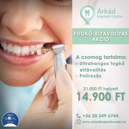 Fogkő eltávolítás AKCIÓ