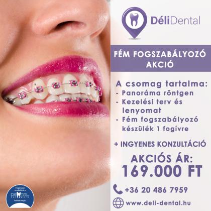 Fém Fogszabályozó Akció