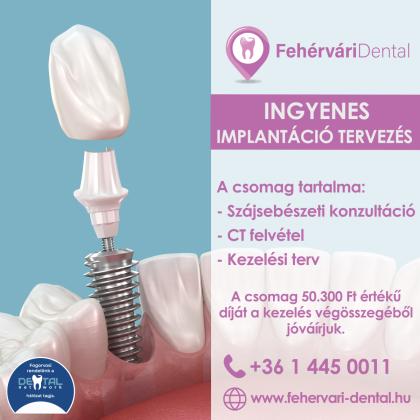 Ingyenes implantáció tervezés
