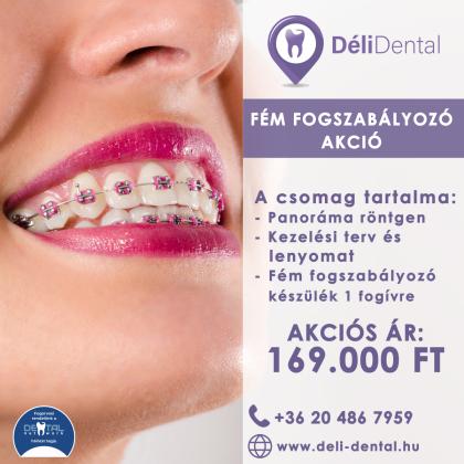 Fém Fogszabályozó Akció