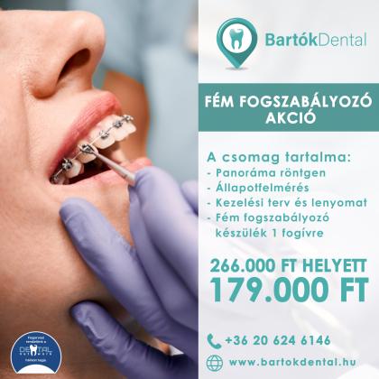 Fém Fogszabályozó Akció Fém Fogszabályozó Akció