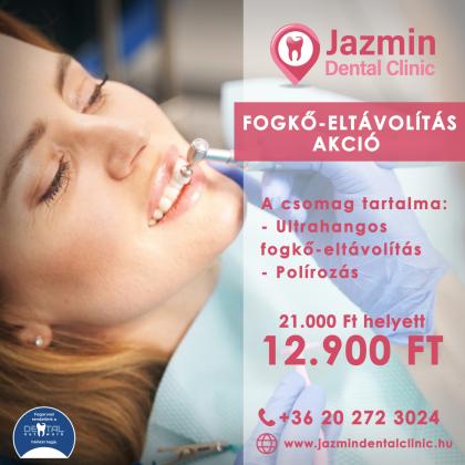 Fogkő Eltávolítás Akció Fogkő Eltávolítás Akció