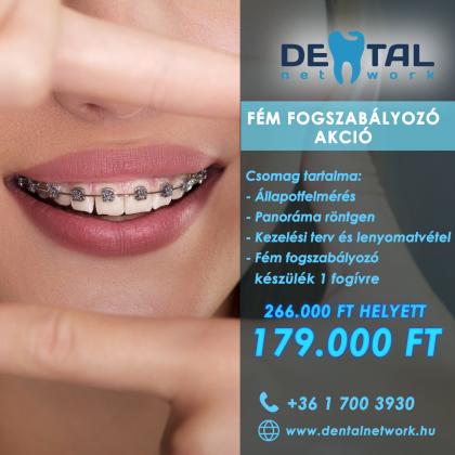 Fém Fogszabályozó Akció Fém Fogszabályozó Akció