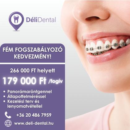 Fém Fogszabályozó Akció Fém Fogszabályozó Akció