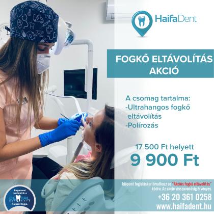 Fogkő Eltávolítás Akció Fogkő Eltávolítás Akció