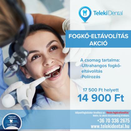Fogkő eltávolítás AKCIÓ Fogkő eltávolítás AKCIÓ