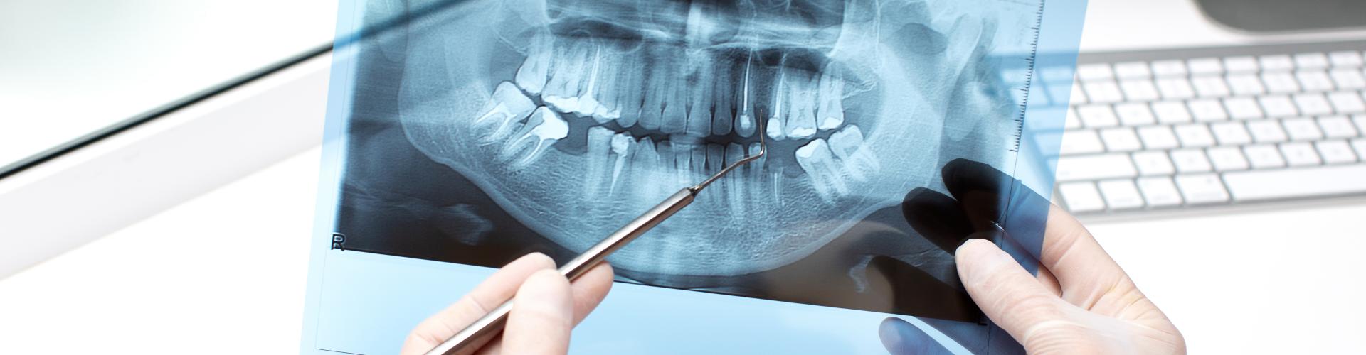 Panoráma röntgen fontossága a fogászatban