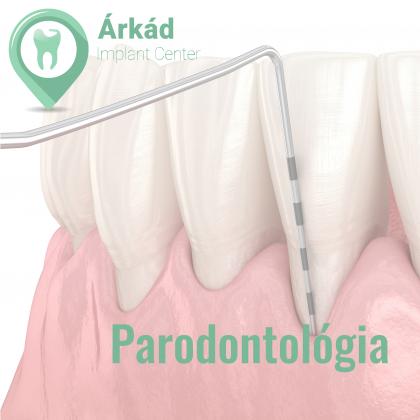 Parodontológia - fogágybetegség