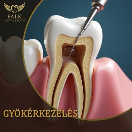 Root canal treatment