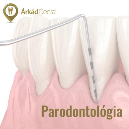 Parodontológia - fogágybetegség