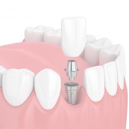 Dental implant